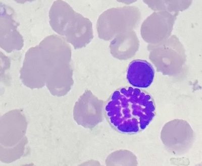 Morphology of Mitotic Figures in Bone Marrow Aspirate