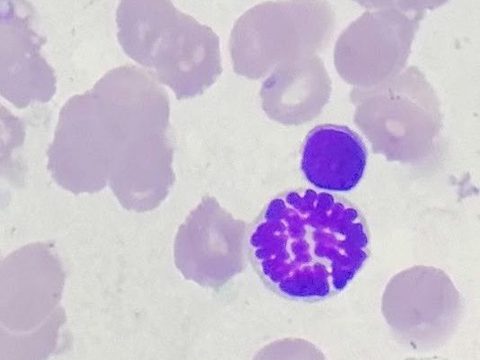 Bone marrow smear: mitotic figure next to a normoblast nucleus