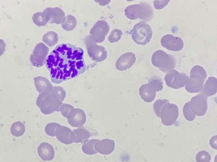 Bone marrow smear: chromosomes of a dividing cell in metaphase