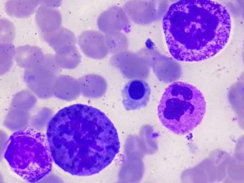 Bone marrow smear: cell in prophase of mitosis next to a myelocyte