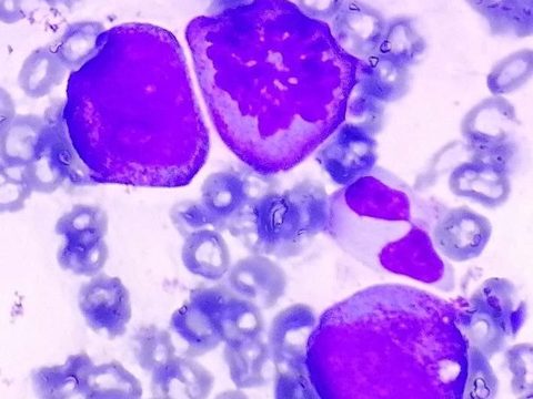 Bone marrow smear: chromosomal plate of a dividing precursor