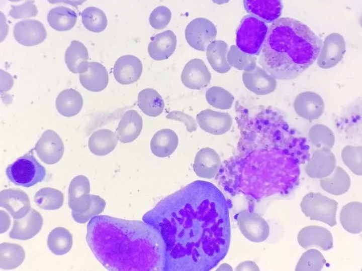 Bone marrow smear: mitotic figure next to a myelocyte and a destroyed cell