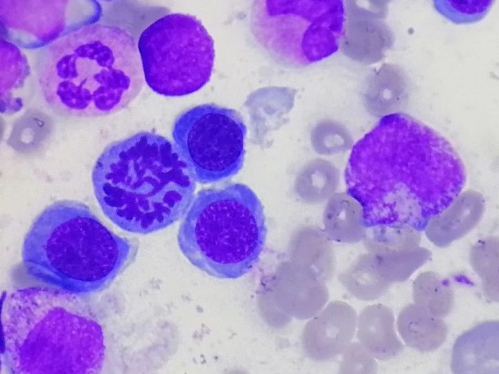 Bone marrow smear: mitosis among normoblasts of the erythroid lineage