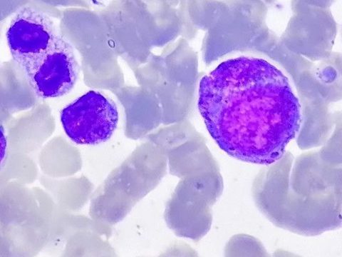 Bone marrow smear: prophase of mitosis of a large bone marrow precursor
