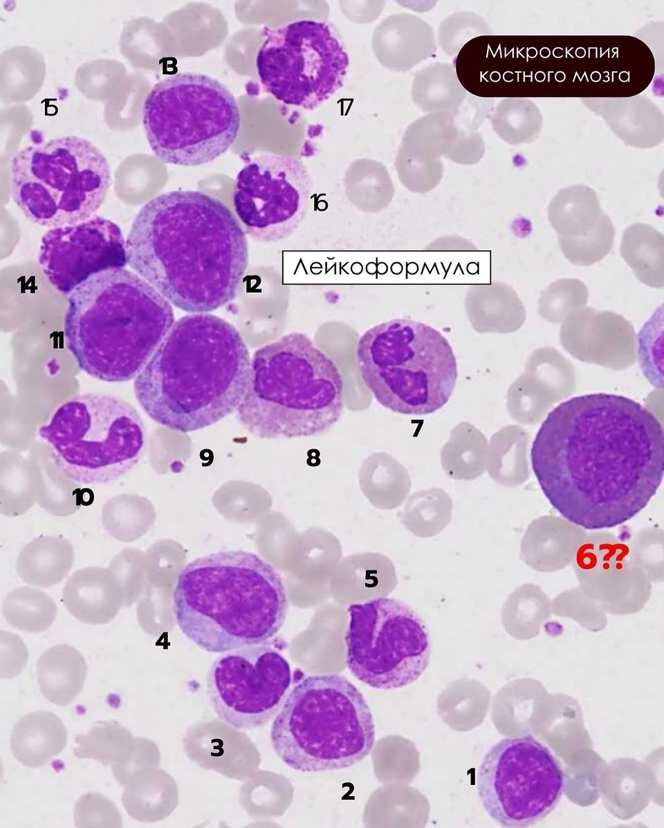 Bone marrow smear with granulocytic cells at different stages of maturation