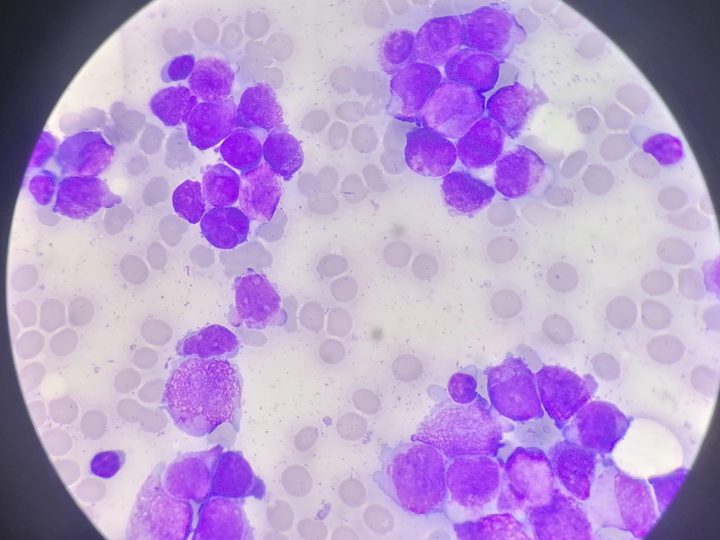 Мазок костного мозга, скопления атипичных промиелоцитов с полиморфными ядрами
