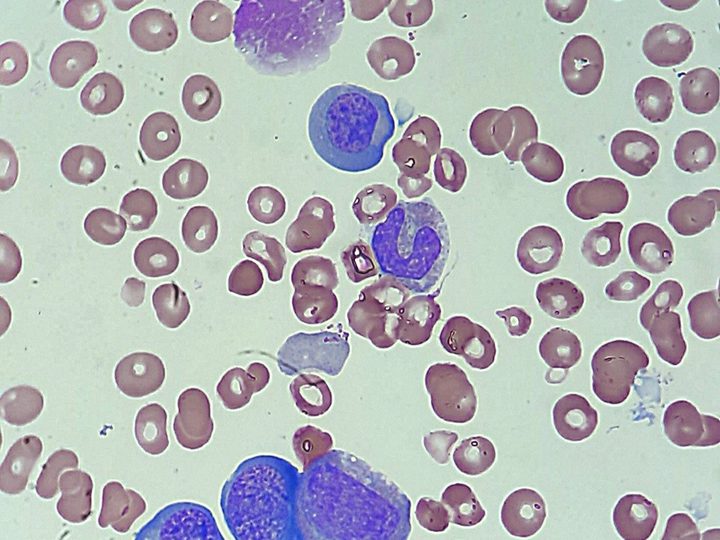 Bone marrow smear: normoblasts and maturing myeloid cells