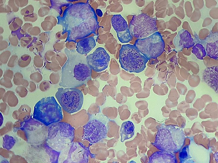 Bone marrow smear: a cell-rich field with granulocytopoiesis precursors