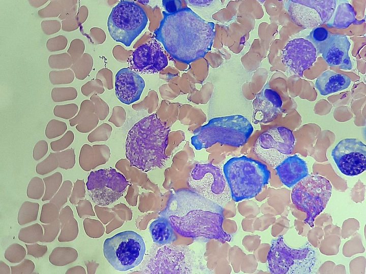 Bone marrow smear: preserved maturation of myeloid and erythroid lineages