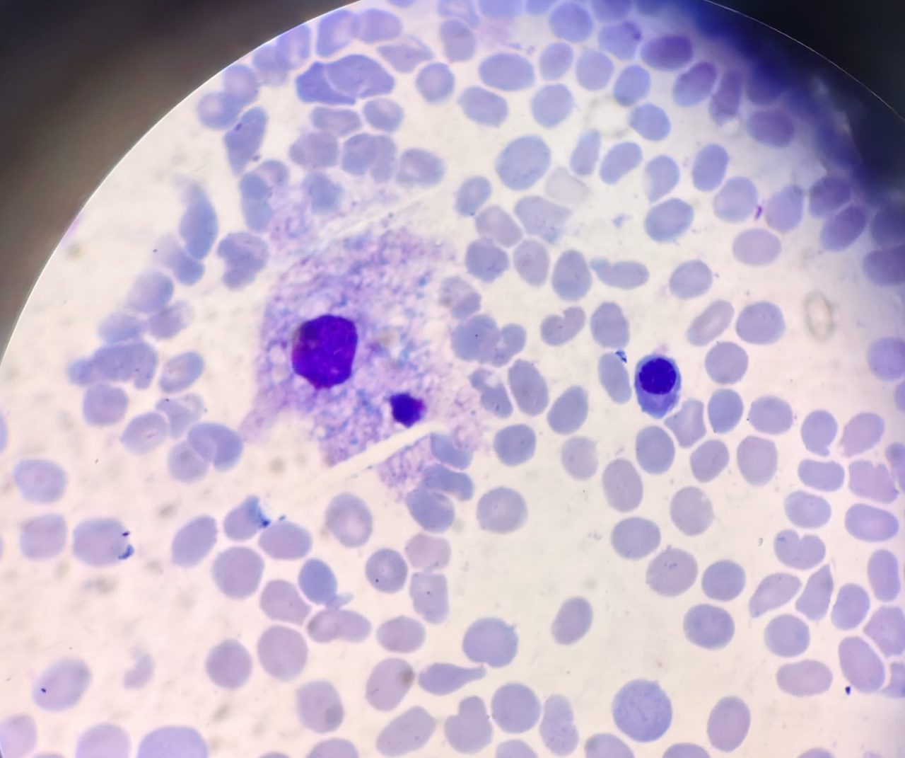 Bone Marrow Morphology in Multiple Myeloma