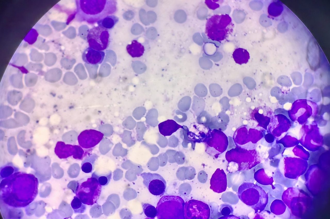 Bone Marrow Morphology in Multiple Myeloma