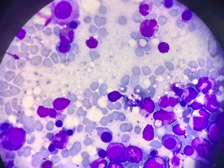 Bone marrow smear, cellular aspirate with preserved maturation of cell lines