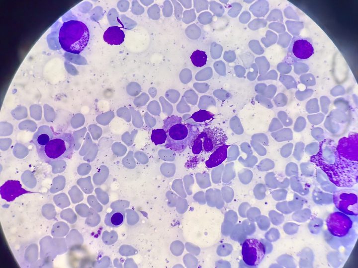 Bone marrow smear, plasma cell with signs of cytoplasmic clasmatosis
