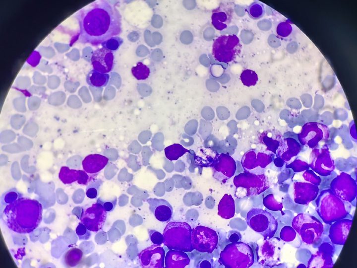 Bone marrow smear, cluster of maturing granulocytes and normoblasts