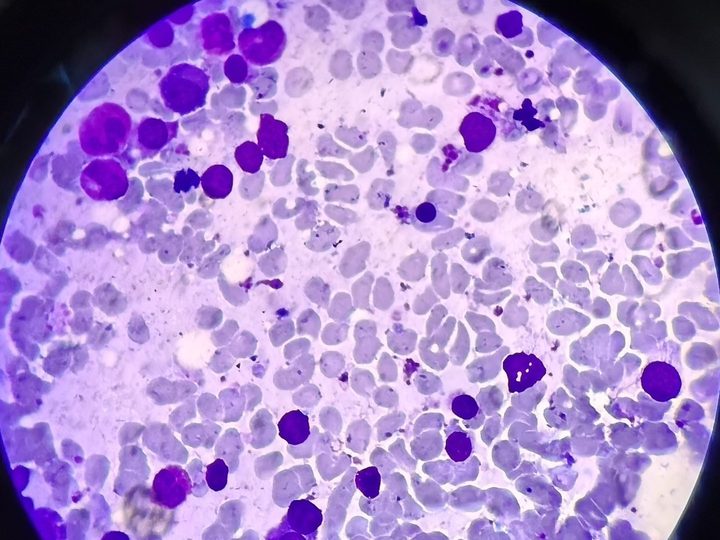 Bone marrow smear, predominance of normoblastic erythropoiesis