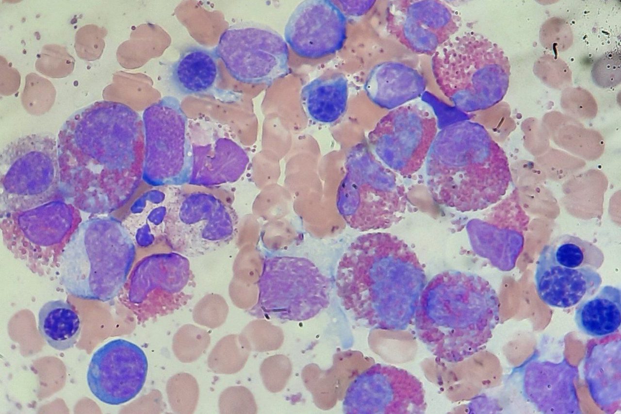 Bone Marrow Morphology in Severe Hypereosinophilia