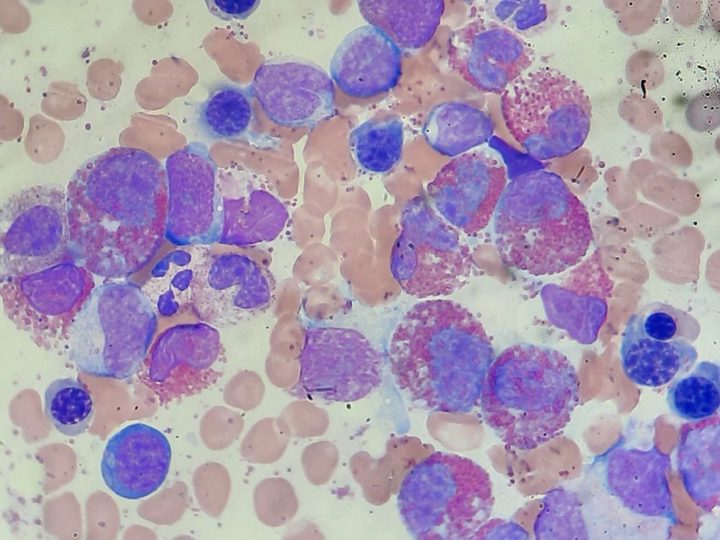 Bone marrow smear: precursors and mature eosinophils with characteristic granulation