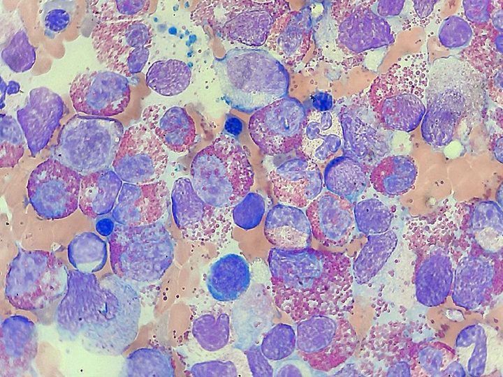 Bone marrow smear: massive accumulation of eosinophils and cell degranulation