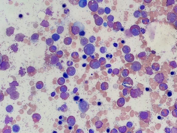 Bone marrow smear, overview: sharp predominance of the eosinophilic lineage