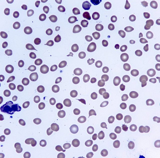 Blood Smear Morphology in Primary Myelofibrosis
