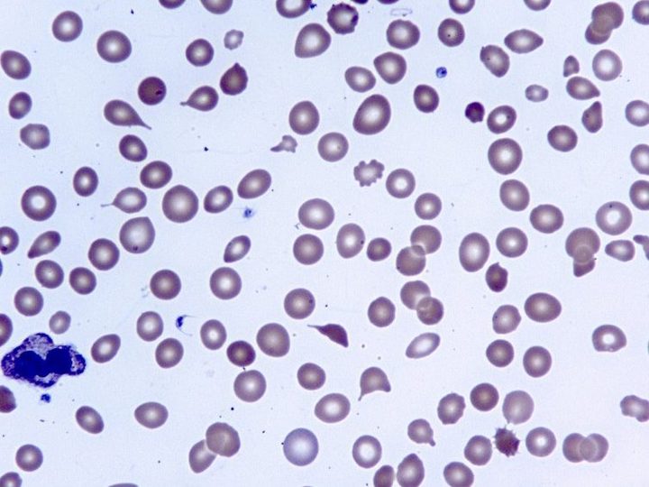 Blood smear: poikilocytosis with a predominance of tear-drop cells — dacryocytes