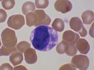 Blood smear: circulating micromegakaryocyte with a dense, round nucleus