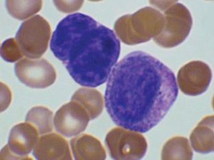 Blood smear: naked megakaryocyte nuclei against a background of anisopoikilocytosis