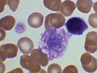 Blood smear: giant platelet and micromegakaryocyte among poikilocytes