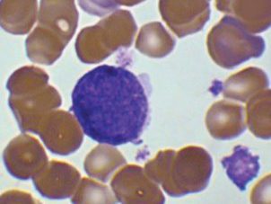 Blood smear: megakaryocytic cell with signs of platelet budding