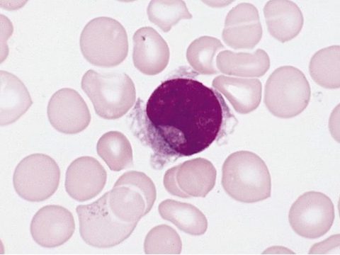 Blood smear: transitional form between megakaryoblast and micromegakaryocyte
