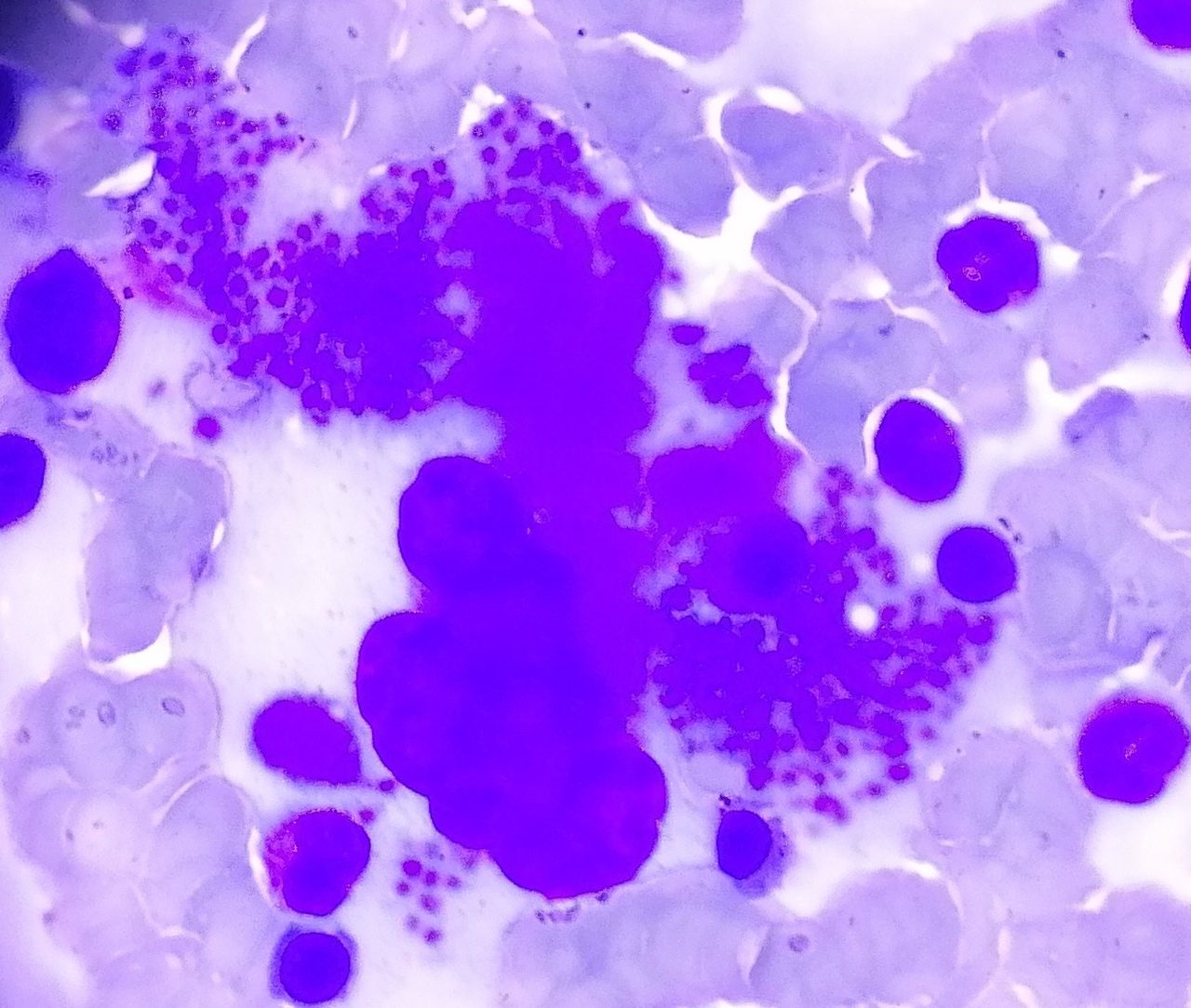 Bone Marrow Megakaryocyte Morphology in Thrombocytosis