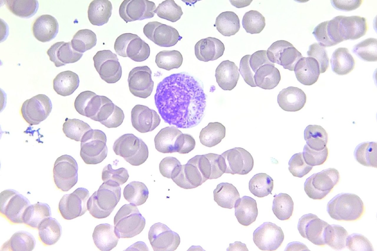Myelocyte Morphology in Peripheral Blood Smears