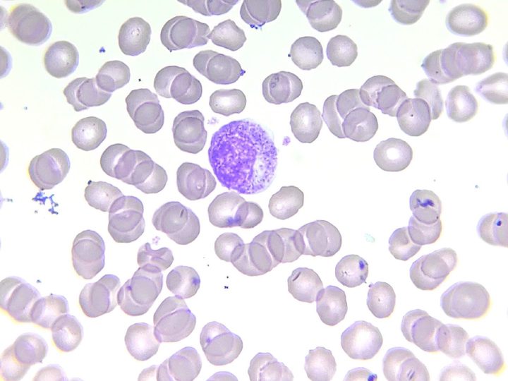 Blood smear: neutrophilic myelocyte with specific granulation