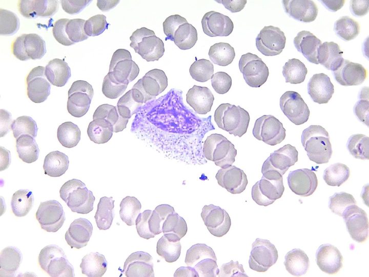 Blood smear: myelocyte with eccentric nucleus and abundant cytoplasm