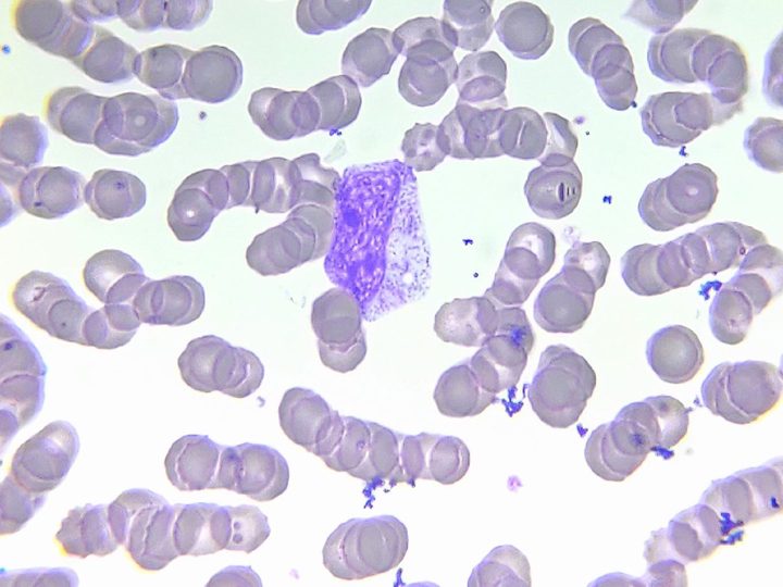 Blood smear: myelocyte with characteristic clumpy chromatin without nucleoli