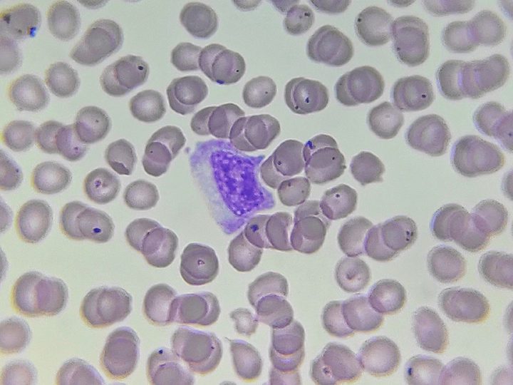Blood smear: myelocyte with basophilic cytoplasm and clear nuclear contour