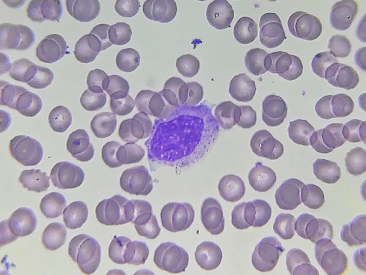 Blood smear: neutrophilic myelocyte with a round nucleus in the center of the field