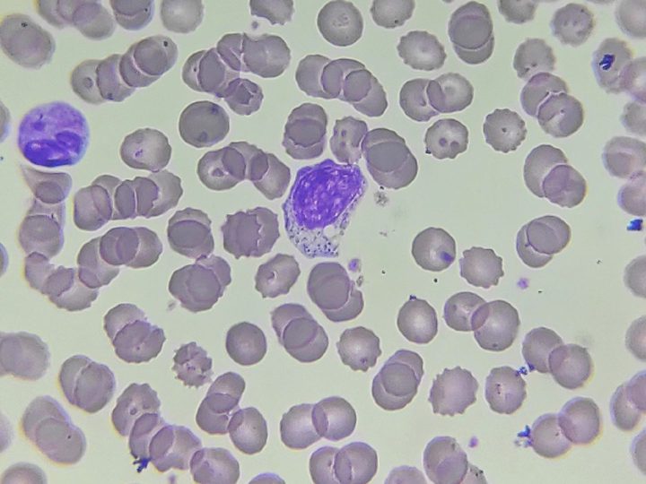 Blood smear: myelocyte in the center of the field and a granulocyte on the left