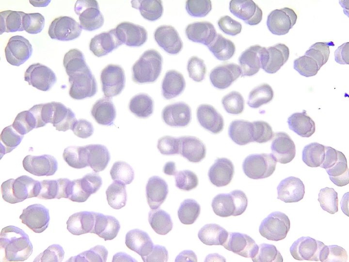 Blood smear: two myelocytes with abundant specific granulation