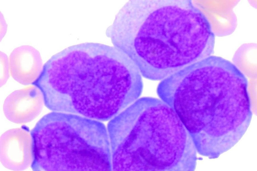 Морфология монобластов и промоноцитов при ОМЛ М5a