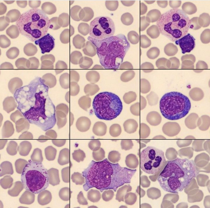 Blood smear: photomicrographs of leukocytes for differential diagnosis of monocytes