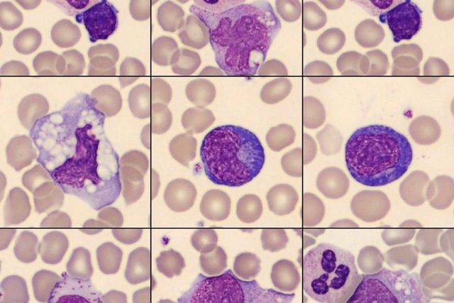 Monocyte Morphology and Differential Diagnosis in Blood Smears