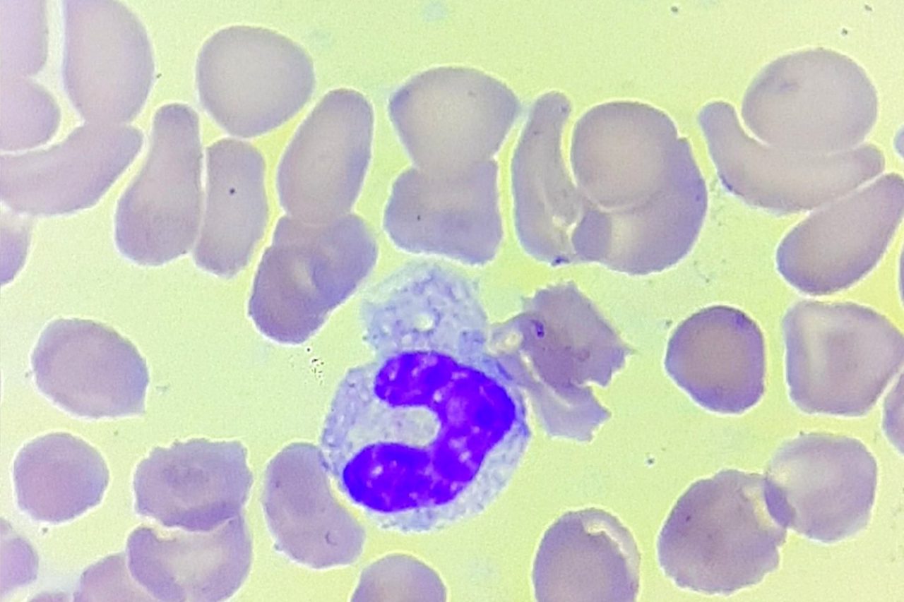 Neutrophil Morphology in Sepsis: Blood Smear Analysis