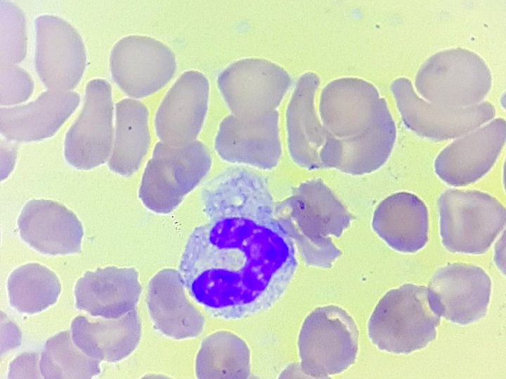 Blood smear: band neutrophil with signs of toxic cytoplasmic destruction