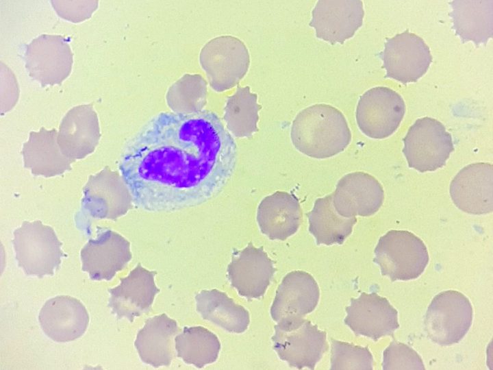 Blood smear: neutrophil with a large basophilic Kniazkov-Dele body and vacuoles