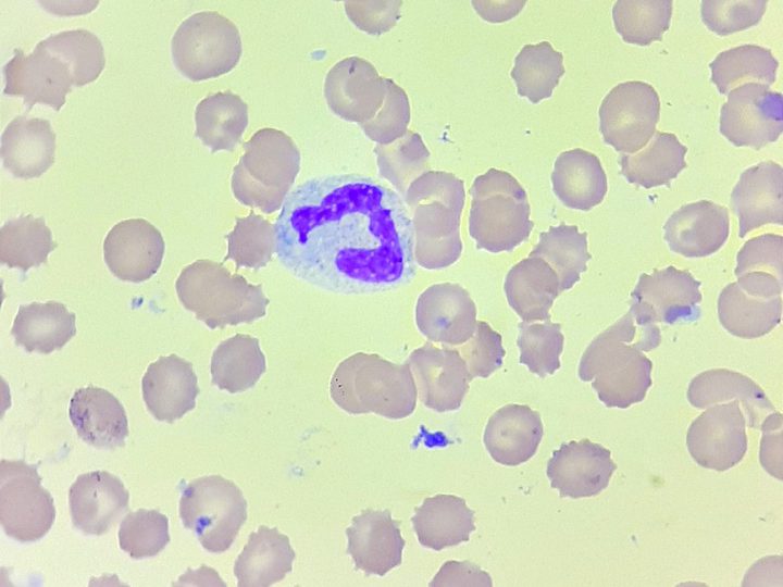 Blood smear: band neutrophil with a left shift amidst poikilocytosis