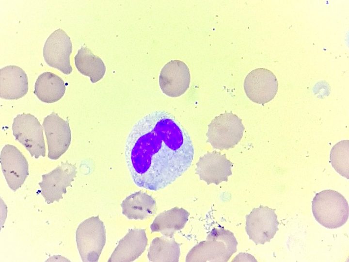 Blood smear: segmented neutrophil with a Kniazkov-Dele body at the cell edge