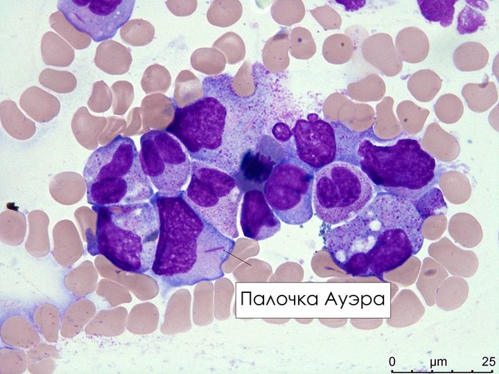 Мазок костного мозга: единичная тонкая палочка Ауэра в цитоплазме миелобласта