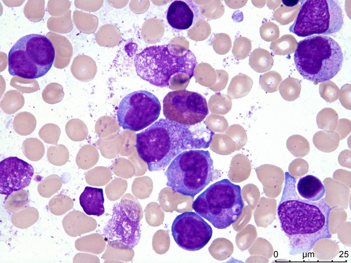 Мазок костного мозга: бласты макрогенерации с плеоморфными ядрами и крупными ядрышками