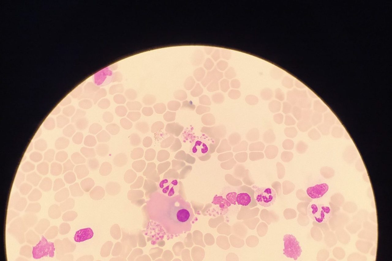 Plasma Cell Morphology and Atypical Forms